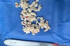 每天两碗！男子体内密密麻麻长满“石头”！很多深圳人也爱喝图片