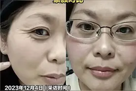 42岁“断崖式衰老”上热搜！专家：较少见，但这些是早衰常见症状图片