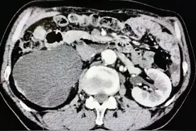 多年结石不重视，大爷不得已摘患肾！医生解读不同结石分别怎样处理图片