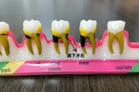 只想洗牙，为什么医生却为我做刮治？图片