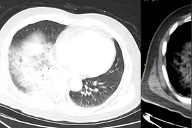 双肺全白，抢救12天！医生提醒：早期症状似感冒图片