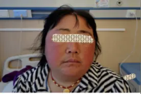 云南首例！为库欣病患者精准“揪”病灶，这家医院有新技术图片