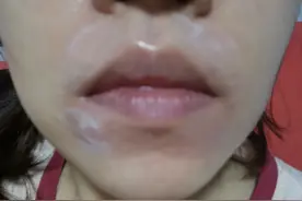 使用脱毛膏导致烧伤！专家：敏感部位更易引起不良反应图片