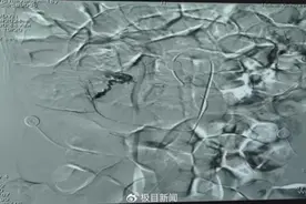 18岁大学生连续熬夜，消化道出血3000毫升？医生提醒！图片