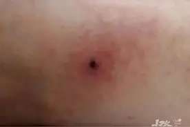 女子不明原因持续高烧40度！身上这个“标记”锁定“元凶”图片