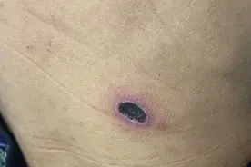 衢州采茶大爷发热迟迟不见好转，原来是这种虫子惹的祸图片