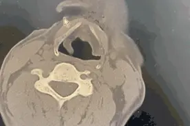 惊险！工人锯树时摔倒，树枝插入喉咙图片