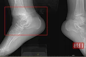 体验滑板的“速度与激情”，男子不慎崴伤脚踝致严重骨折图片