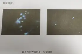 12岁男孩的“脚气”长到脸上，医生提醒：注意分开使用生活用品图片