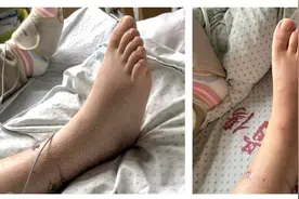 骨折后肿胀难消？别担心，小小一根药棒就能散寒止痛图片