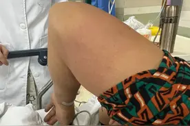 62岁阿姨捡山核桃时，被它咬了十几口，休克倒地！最近杭州有医院连续接诊多例图片