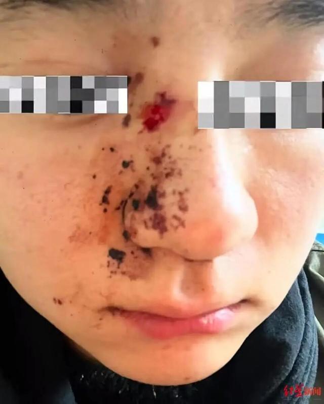 男子因质问女子遛狗不牵绳被打骨折，当事人：打人者毫无悔意，认罚认赔就是不认罪，一审获刑一年