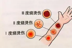 春节期间若遇意外烧烫伤，这些急救处理方法您一定要知道！图片