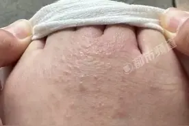 女子商场试鞋，回家后瘙痒难耐，一看密密麻麻全是……图片