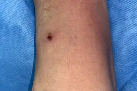 昆虫叮咬后涉水，男子右脚肿成“包子”……医生提醒，被昆虫叮咬后避免搔抓图片