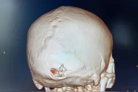 后脑勺包块竟导致颅骨破坏？医生提醒：头部包块应及时就医评估图片
