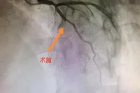按摩也不能缓解的背痛竟是急性心梗，医生：警惕这些非典型信号图片