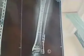 热闻|女子穿7cm厚洞洞鞋崴脚粉碎性骨折，三岁男孩曾被切断脚趾图片