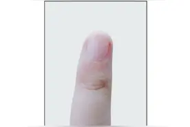 指甲突然出现黑线可能是癌变图片