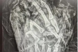 广州一男子手掌不慎遭绞断，专家：立即就医，注意断肢保存！图片