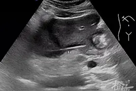 杭州男子反复高烧三周，体温超过39℃！检查发现，肝脏里竟插了一根牙签图片