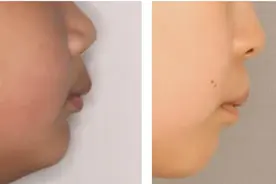 家长需警惕！下颌发育不足影响孩子健康与颜值图片