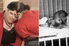 “世上最年长连体双胞胎”去世，终年62岁  一人健康、一人残疾，曾被断言活不过30岁图片