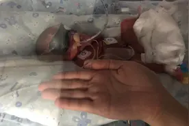 双胞胎姐妹出生时间相隔3天，背后的救治故事令人感动图片