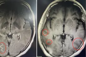 一天吃六颗止痛药都止不了头痛，女子确诊隐球菌脑膜炎图片
