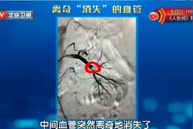 血管堵没堵，就看这2处！一个动作，激活脚上的“化血栓开关”图片