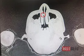 复查肺炎时扫出“漏网之鱼”，小玩具竟在男孩鼻内“住”了4年图片