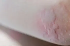 春光正好，别被皮肤过敏“撂倒”！这份脱敏指南请收好图片