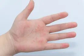 天热为啥手上长了一粒粒“小红点”？图片