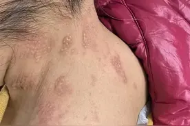 永医科普丨关注带状疱疹 别让“蛇缠腰”缠上你的健康生活图片
