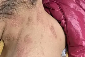 永医科普丨关注带状疱疹 别让“蛇缠腰”缠上你的健康生活图片