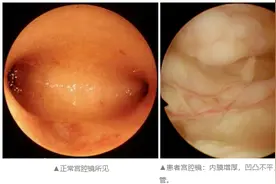 东莞一22岁女孩竟查出子宫内膜癌！不要小看妇科内分泌那点事儿图片