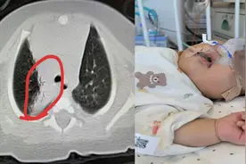 山东大学齐鲁医院（青岛）儿内科为1月龄宝宝完成支气管镜探查，明确病因精准施治图片