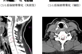 全省首例！滨州市中医医院（滨州市医学院附属中医医院）成功开展颈椎经椎体入路脊柱内镜手术图片