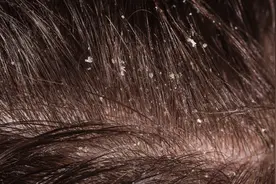 头屑多得像下雪……济阳区中医医院皮肤科专家为您支招图片