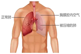 知名音乐人因它去世，一文带你深入了解“气胸”，什么人容易得？图片