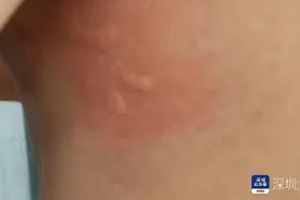 深圳一游客下海玩水被水母蛰伤，出现皮肤过敏反应图片
