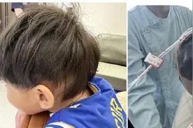 巨大黑毛痣覆盖大半个头皮，2岁宝宝“换肤”成功！图片