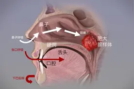 经常张口呼吸会变丑？网传的闭嘴贴到底有没有用图片