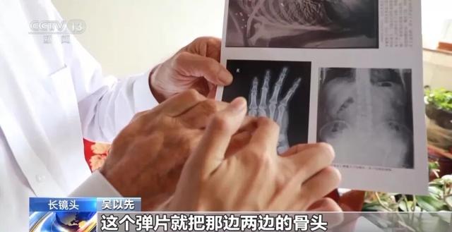 “老先生，您把项链取下来再做CT”“你看是不是弹片”