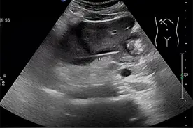 杭州男子反复高烧三周，体温飙升超39℃！确诊结果让所有人意外，怎么会……图片