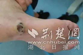 多年的足底黑痣竟化脓溃烂险危及性命 医生：是恶性黑色素瘤图片