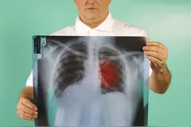 肺结节是肺癌吗？肺结节有几大诱因，您是易患人群吗？图片