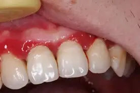 一种让牙齿容易脱落的病 很多人年轻时不重视图片