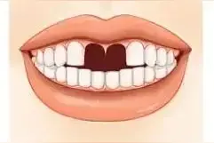 紧急！牙齿意外脱落怎么办？千万别扔，这么做还有救！图片