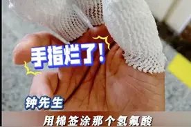 警惕！一男子工作时用手拿棉签触碰氢氟酸，三根手指“烂出黑洞”……医生提醒图片
